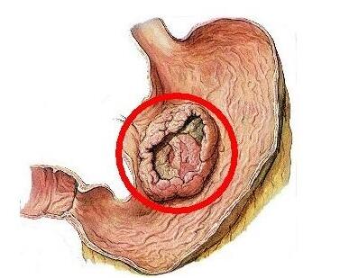 胃癌晚期人参皂苷rh2作用于淋巴转移