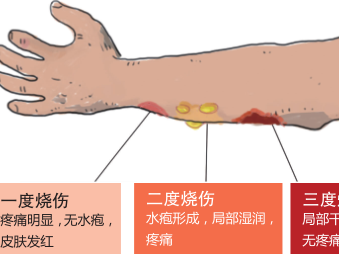 爱无痕烧烫伤公益的个人展示页