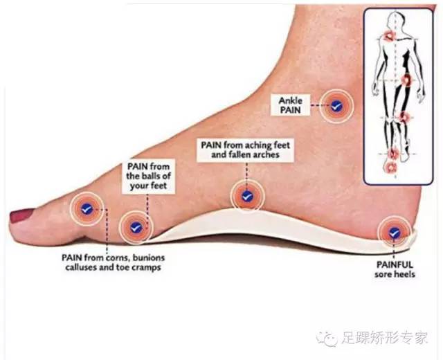 精华篇:关于扁平足,一文读懂怎样预防或治疗最有效