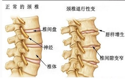 颈椎骨刺越大病情越严重?出现哪些情况应就医