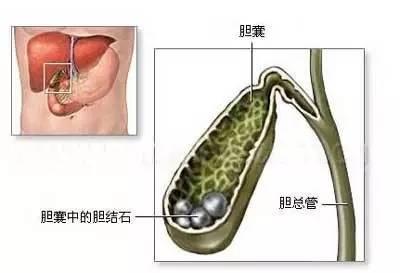 高血脂的你未来会得什么病?降脂汤血脂血栓全溶光