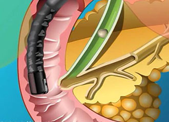胆管结石的症状有哪些