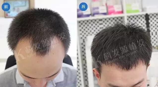 植发后发际线非常完美以上这两位发友都是通过植发来改善自己的脱发