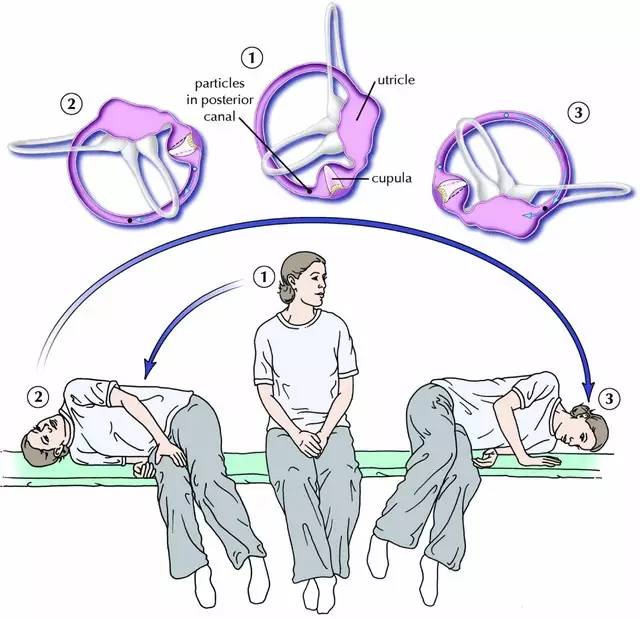 耳石症最有效的治疗方法