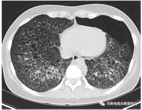 肺部磨玻璃影是什么东东?先来科普下