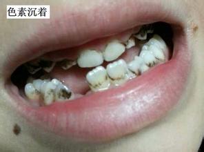 上海哪里看牙齿根部发黑好?