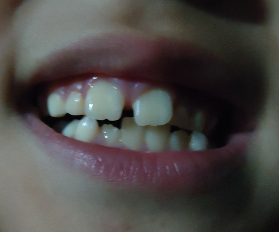 一岁半宝宝牙齿缝隙发黑,怎么回事