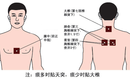 慢性支气管炎,咳喘,冬天易受凉等寒性病症患者贴敷部位主要为定喘穴和