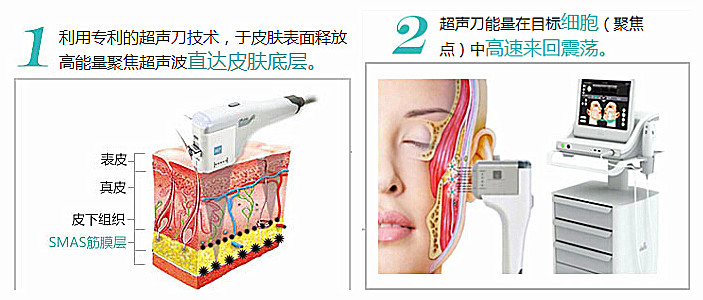 为什么"超声刀"这么火?