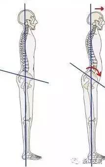 骨盆前倾有何危害