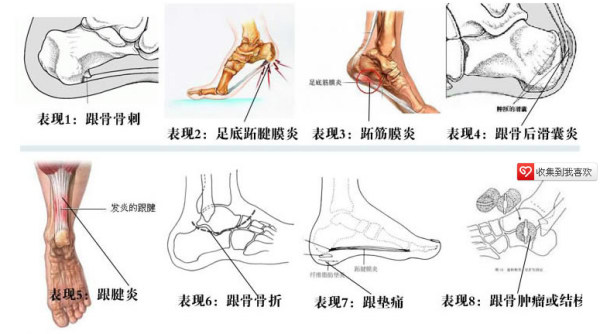 我的脚后跟特别疼,大夫说骨刺,说这个很难根治,我这么