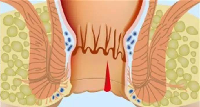 顾名思义,肛裂就是肛门部有裂口.