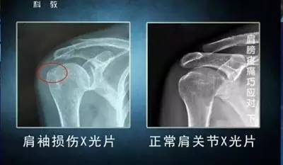 部分肩袖损伤患者肩峰前外侧缘及大结节处有明显骨质增生.