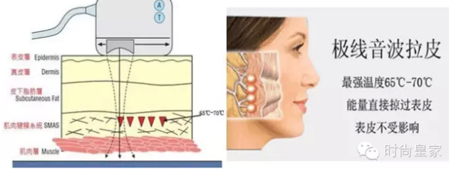 从体外使体内的smas层热凝固,产生拉紧并提升,达到筋膜悬吊拉皮的效果