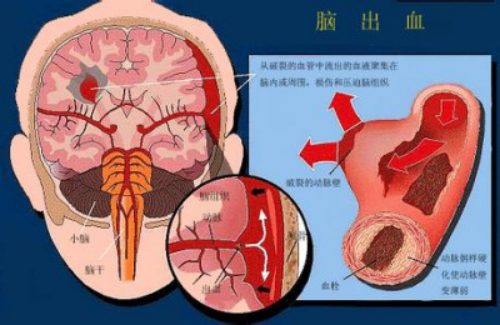 脑出血头痛怎么办