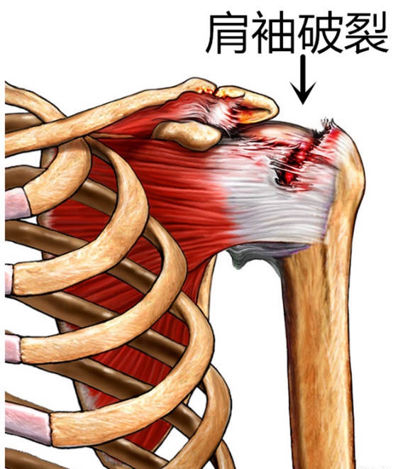 肩袖破裂患者讲述台湾微创肩关节镜手术经历