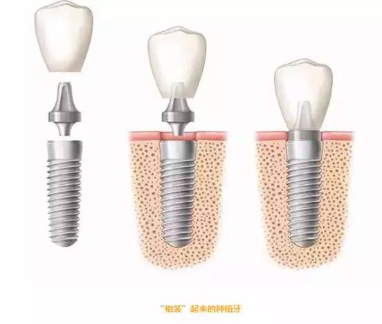 但天然牙的各个部分是有机地结合在一起,而种植牙是靠螺丝或粘接剂