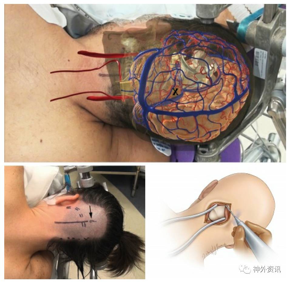 图9. 左侧的小脑上入路能保护窦汇以及通常为右侧优势的直窦和横窦.