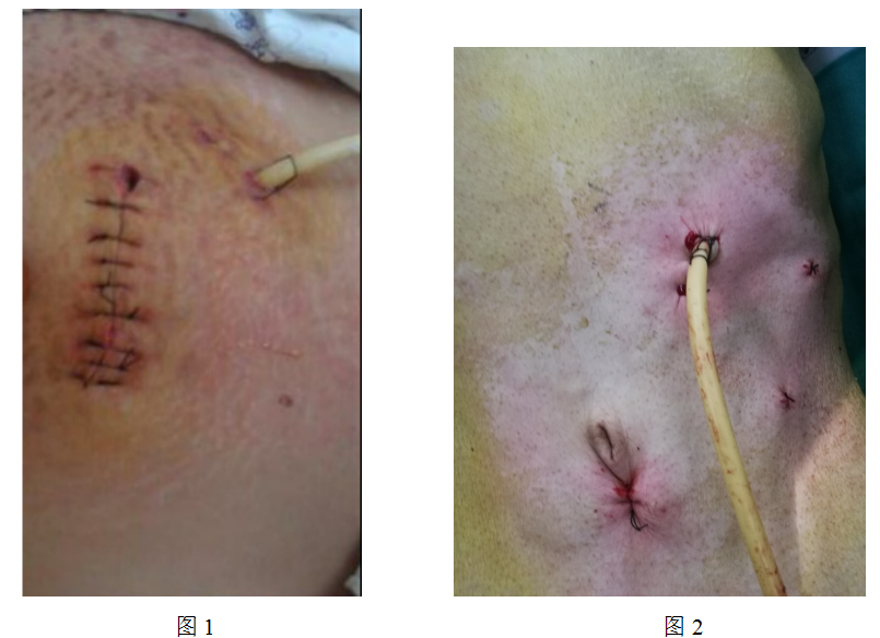微创胃造瘘相比传统开腹手术,创伤小,时间短,术后恢复快,病人心理负担
