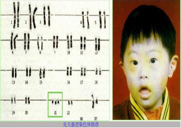 染色体核型分析在染色体病诊断中的应用