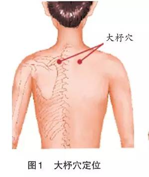 见图1～3. 操作:大杼,肩外俞两穴用双罐艾灸罐灸,京骨穴用温和灸.