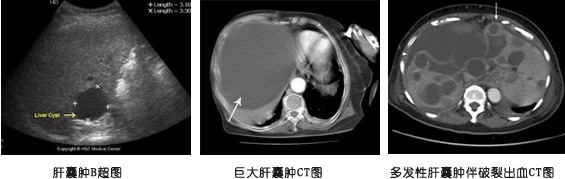 肝囊肿是怎么回事