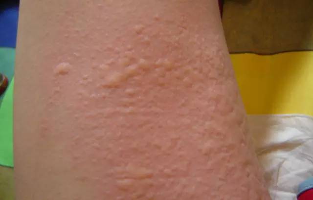 荨麻疹是过敏性皮肤病中最高发的疾病之一,而在这其中,冬天发病的人数