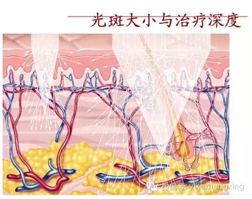 vbeam 脉冲染料激光-治疗血管性病变的金标准