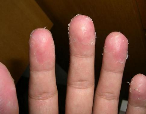 手指脱皮最有效的治疗方法了!简单有效治蜕皮