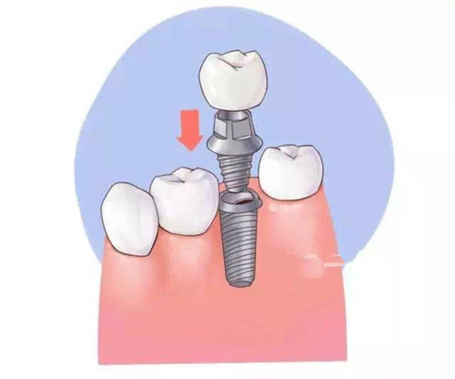 什么是种植牙?种植牙好不好?