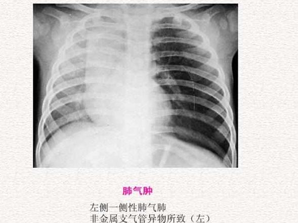 肺气肿与慢性阻塞性肺疾病的区别和疗法!