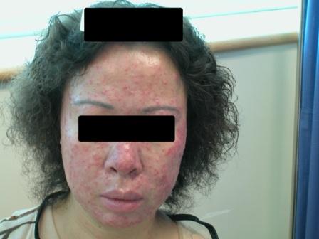 痤疮皮炎型:粉刺,丘疹,脓疱;面部皮炎型:皮肤变薄,潮红伴毛细血管扩张