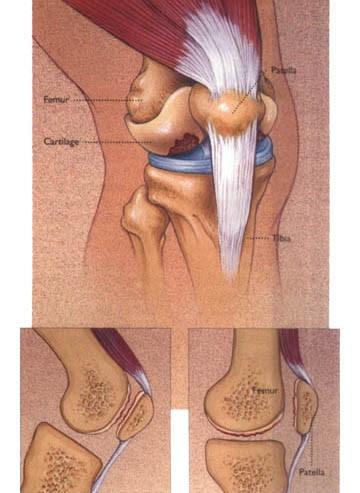 髌骨软化症的诊断及锻炼方法