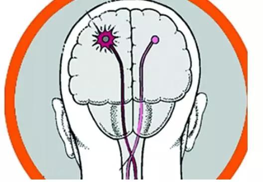 使病人出现偏瘫,失语,偏侧肢体麻木等情况,部分脑干梗塞和大面积脑梗