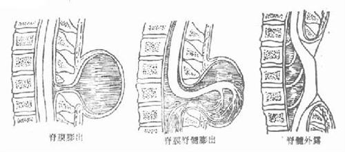 孩子背后长了"小尾巴"小心脊髓脊膜膨出