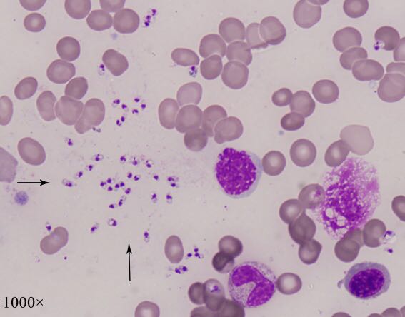 附图1患者骨髓涂片可见大量利什曼原虫抗体 北京友谊医院郑杨整理