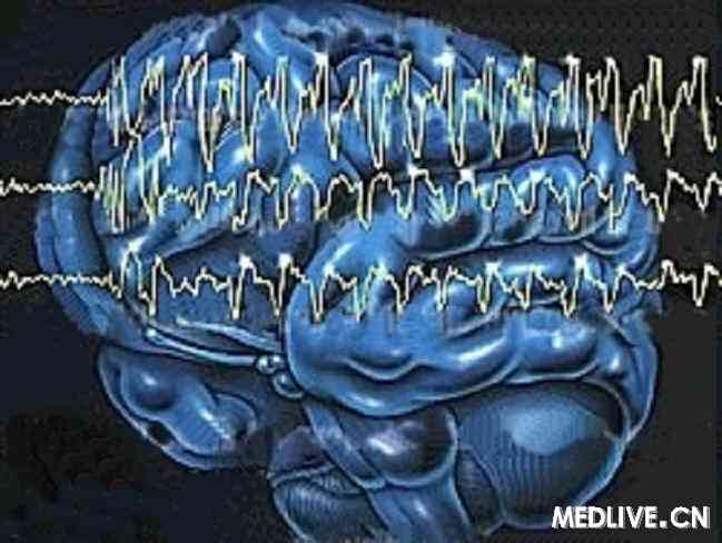 癫痫的不同脑电图检查,你全都了解吗?