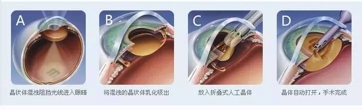 【名医视点"我想看清世界"三焦点人工晶状体植入手术见证奇迹!