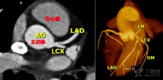 入门必备:冠状动脉 CT 解剖及变异