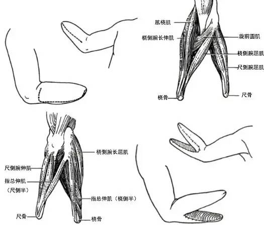 骨哥手术课堂:废弃指前臂残端再植重建部分手功能