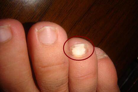 所以当自己脚指甲盖里面有黑点时,一定要注意,确定是不是自己碰的