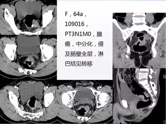 ct检查及诊断攻略―胃癌,结直肠癌