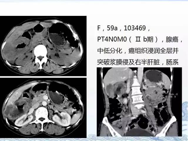 ct检查及诊断攻略―胃癌,结直肠癌