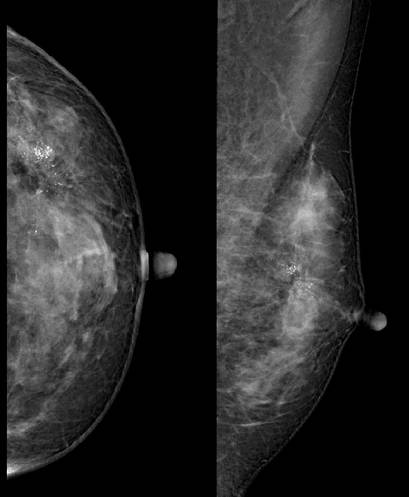 一文读懂丨乳腺癌的影像学表现