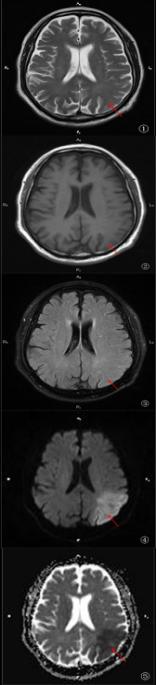 磁共振弥散加权成像dwi在脑梗死分期中的应用