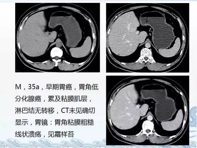 ct检查及诊断攻略―胃癌,结直肠癌