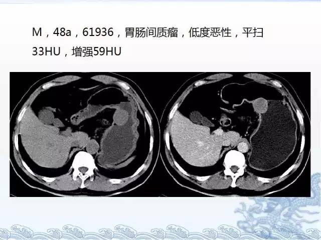 ct检查及诊断攻略——胃癌,结直肠癌