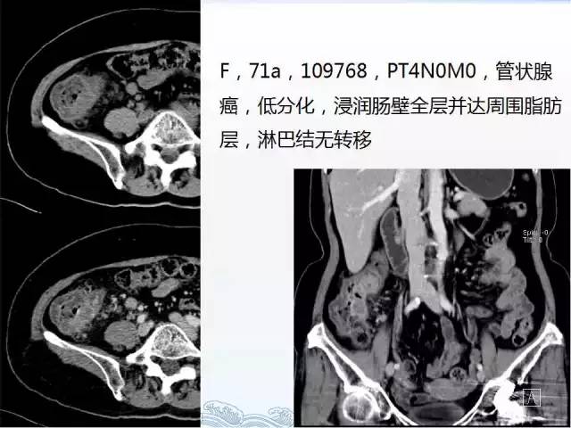 ct检查及诊断攻略―胃癌,结直肠癌