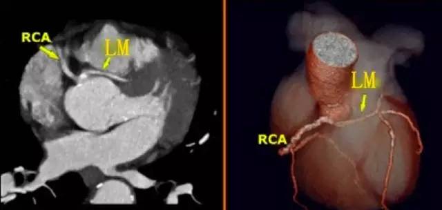 入门必备:冠状动脉 ct 解剖及变异