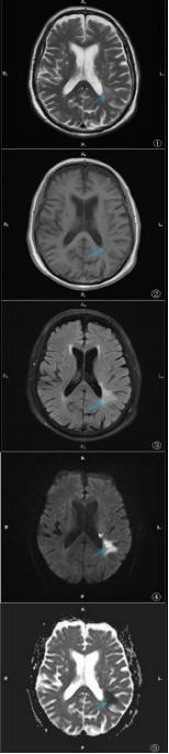 综上所述,dwi信号及adc图的变化反映了脑梗死的演变